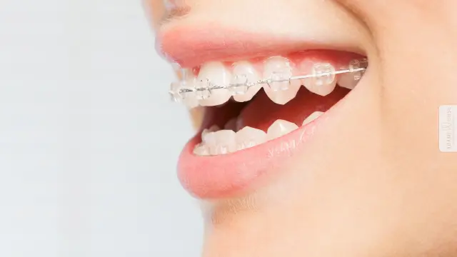 Durchsichtige Brackets