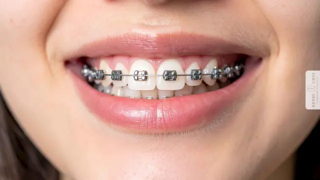 Brackets lösen