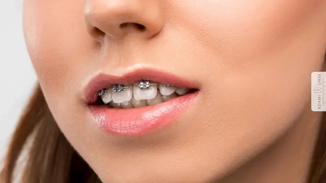 Überbiss veranschaulicht an Beispiel