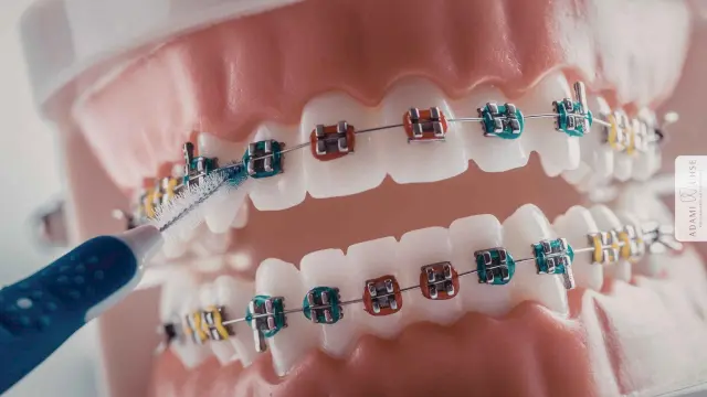 Kieferorthopädie Frühbehandlung Kiefergebiss mit Brackets