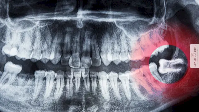 Retinierte Zähne zu sehen im Röntgenbild